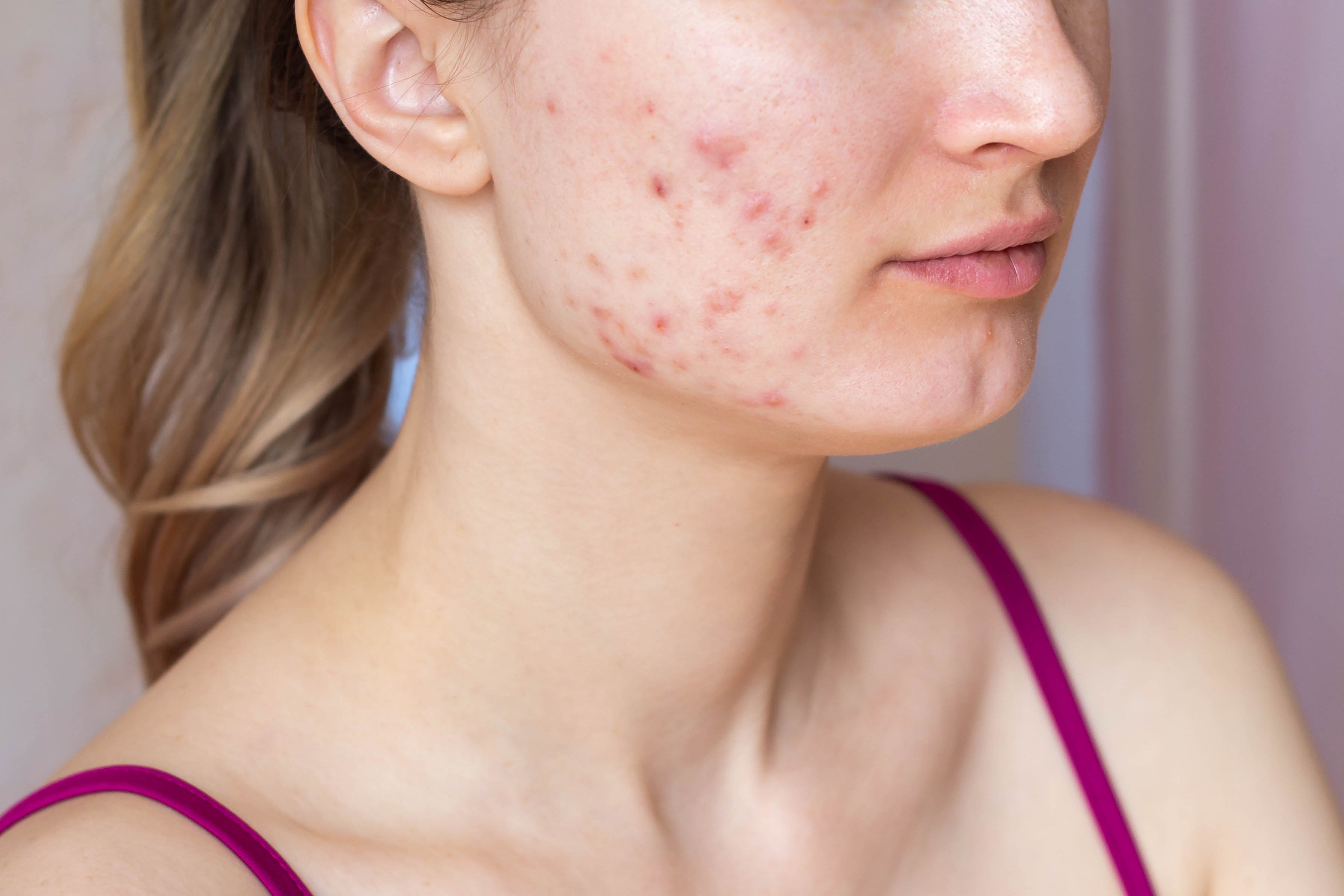 woman with acne on face