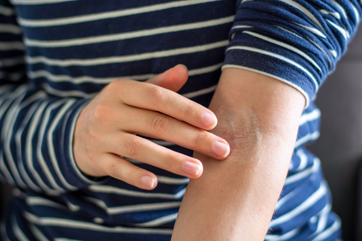 woman applying ointment to irritated flakey skin